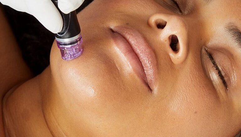 RF microneedling in Kenosha, skin tightening Kenosha, facial rejuvenation Wisconsin