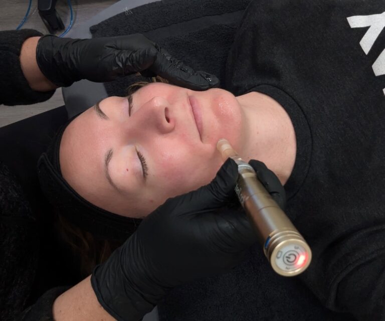RF microneedling in Kenosha, skin tightening Kenosha, facial rejuvenation Wisconsin