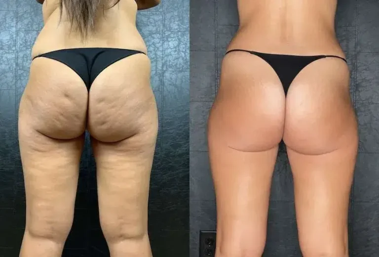 Bella-Vi-Spa-Aesthetics-Exion-Body-Ultrasound-BA-IMG_2406 Bella-Vi-Spa-Aesthetics-Exion-Body-Ultrasound-BA-IMG_2406